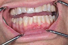 before gingival graft - Las Vegas, NV