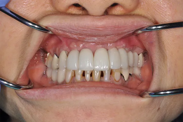 after dental implants - Las Vegas, NV