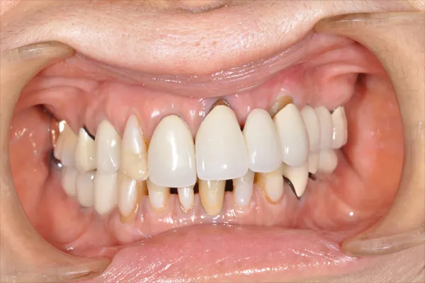 before dental implants - Las Vegas, NV