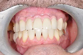 after implant bridge - Las Vegas, NV