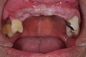 before implant bridge - Las Vegas, NV