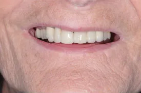after dental bridge - Las Vegas, NV