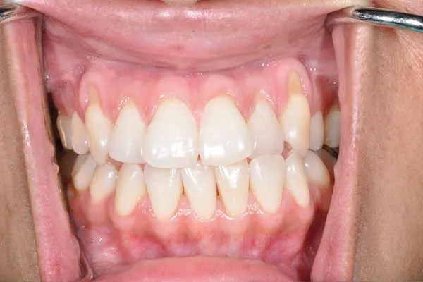 before pinhole surgery - Las Vegas, NV