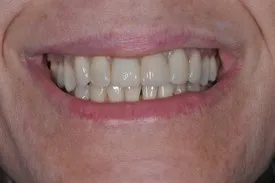 before dental implant - Las Vegas, NV