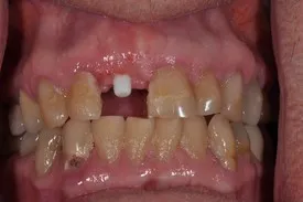 before dental implant - Las Vegas, NV