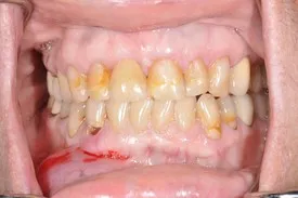 after dental implant - Las Vegas, NV
