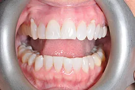 after soft tissue graft - Las Vegas, NV