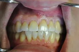 before gum recession treatment - Las Vegas, NV