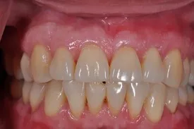 after gum recession treatment - Las Vegas, NV