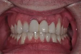 before gum recession treatment - Las Vegas, NV