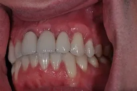 after gum recession treatment - Las Vegas, NV