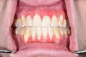 before tissue graft - Las Vegas, NV