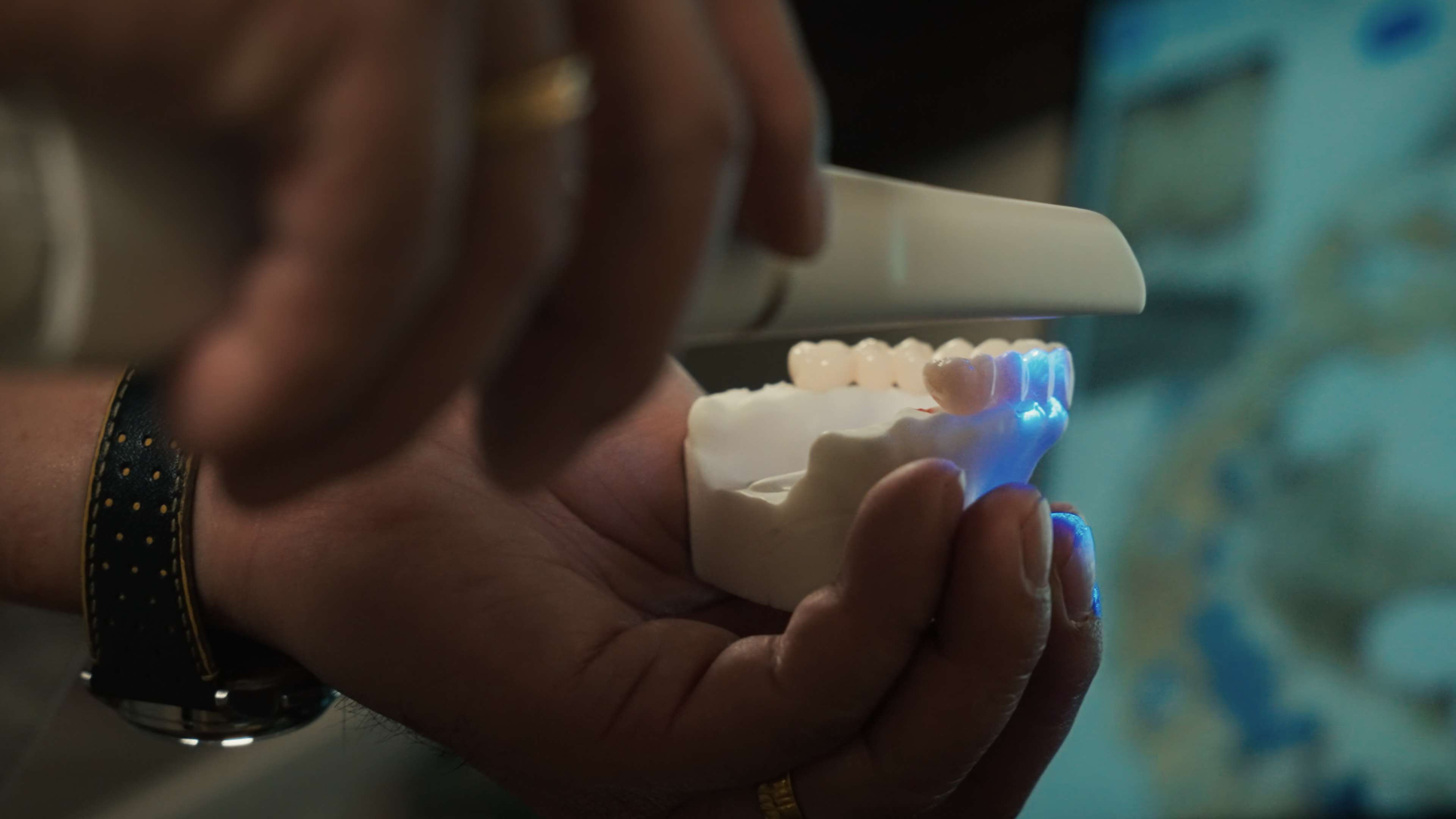 All-on-4 limitations versus 3-on-6 natural gum line
